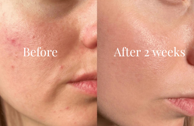 Medicube txa Niacinimide Cream Results